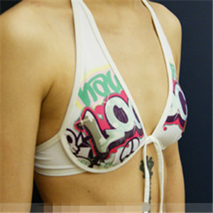 自體脂肪移植隆胸三個月了，分享恢復(fù)前后對比果照片~