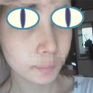 自體耳軟骨隆鼻手術(shù)恢復(fù)過(guò)程分享，還有前后對(duì)比果圖片哦~