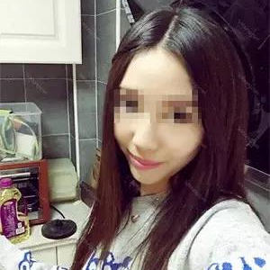 去年做了自體耳軟骨隆鼻手術(shù)，看看我的恢復(fù)過(guò)程照片，前后變化大~