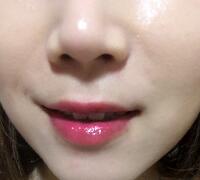 注射玻尿酸除皺價(jià)格3600元，術(shù)后果分享