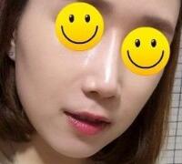 注射玻尿酸除皺價(jià)格3600元，術(shù)后果分享