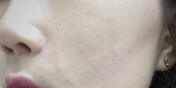 注射完玻尿酸后的照