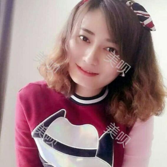 玻尿酸墊下巴后改變了我的大餅臉果漂亮妥妥的