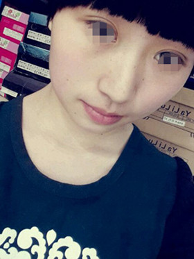 做了切開(kāi)雙眼皮手術(shù)，現(xiàn)在恢復(fù)的還不錯(cuò)哦