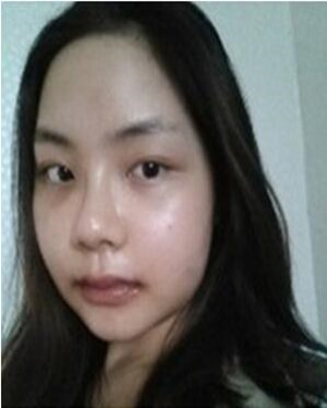 韋敏做的顴骨磨下頜角整形手術(shù)果真的很棒