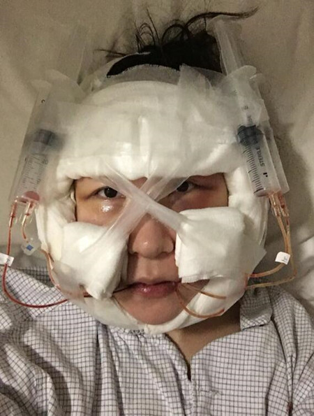 磨下頜角加顴弓截骨降低讓我擁有女神高顏值