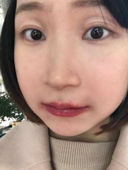 磨下頜角加顴弓截骨降低讓我擁有女神高顏值