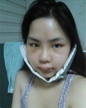 韋敏做的顴骨磨下頜角整形手術(shù)果真的很棒