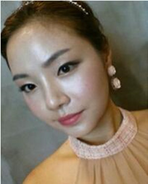 韋敏做的顴骨磨下頜角整形手術(shù)果真的很棒