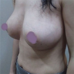 自體脂肪隆胸四個(gè)月了，曬一下恢復(fù)過(guò)程和前后對(duì)比果圖片~