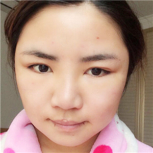 磨骨磨下頜角半年了，分享恢復(fù)過(guò)程和前后對(duì)比果照片哦~