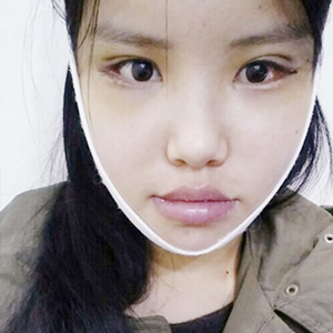 做下頜角整形手術(shù)半年了，給你們看看恢復(fù)過(guò)程照片吧~