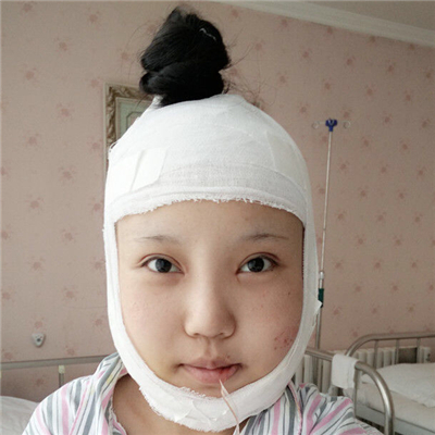 磨下頜角手術(shù)+隆鼻前后對(duì)比果圖片分享，高占巍做的哦~