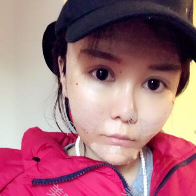 自體脂肪面部填充后年輕了好幾歲呢