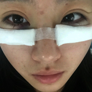 祛眼袋半年了，曬曬我的恢復(fù)前后對比果圖片哦