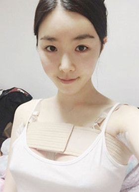 假體隆胸手術(shù)恢復(fù)過程分享，還有前后對比照片哦