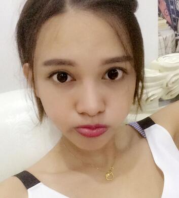 玻尿酸豐太陽(yáng)7天果圖 愛(ài)悅麗格豐太陽(yáng)穴一個(gè)月啦~