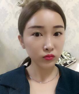 愛(ài)悅麗格玻尿酸豐蘋(píng)果肌、豐下巴、隆鼻