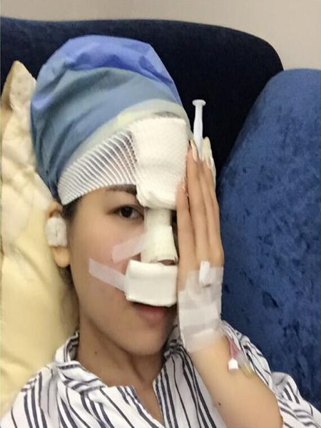 終于做里隆鼻整形手術 快來圍觀我時候果吧