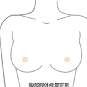 老媽隆胸失敗假體取出，還是自然點好~