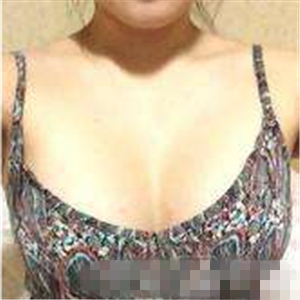 老媽隆胸失敗假體取出，還是自然點好~