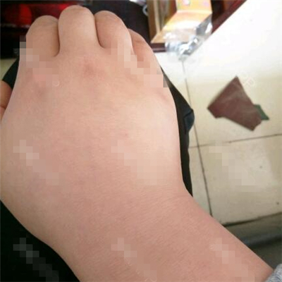 做了副乳吸脂手術(shù)半年了，分享前后對比果圖片~