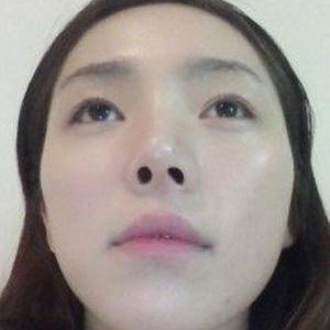 玻尿酸注射豐額頭前后對比果圖片分享，銅雀臺做的哦~