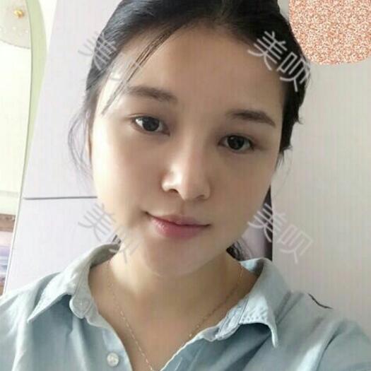 玻尿酸隆鼻改變了大鼻翼給大家分享下我的恢復過程