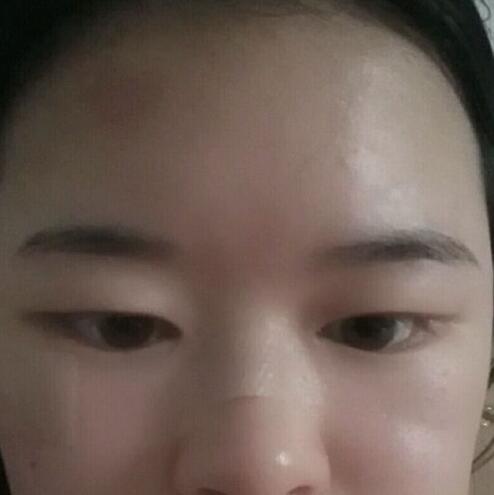 分享手術(shù)切除祛疤恢復(fù)過程希望對大家有幫助