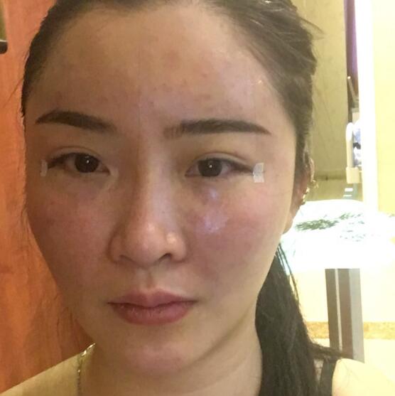 分享我的去胎記過程遺傳性雀斑終于被甩掉了