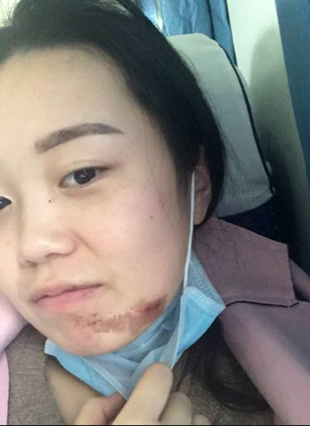 激光祛疤痕整形手術(shù)真的改變了我的人生