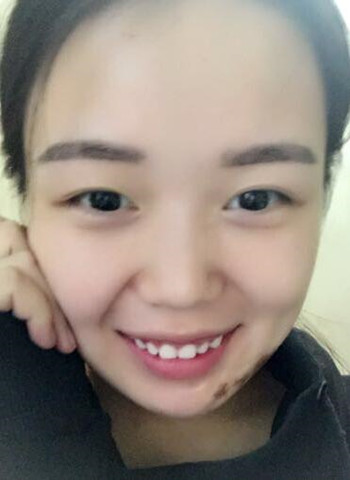 激光祛疤痕整形手術(shù)真的改變了我的人生