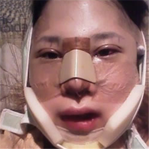 自體脂肪移植隆鼻手術(shù)前后對比果圖片，恢復(fù)過程分享給大家~