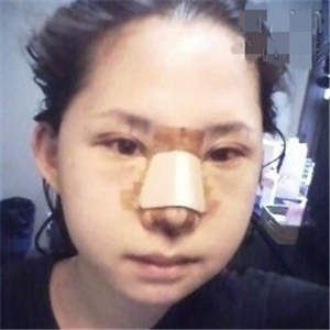 自體脂肪移植隆鼻手術(shù)前后對比果圖片，恢復(fù)過程分享給大家~