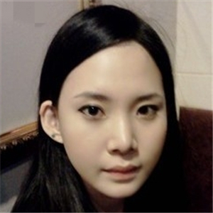 自體脂肪移植隆鼻手術(shù)前后對比果圖片，恢復(fù)過程分享給大家~