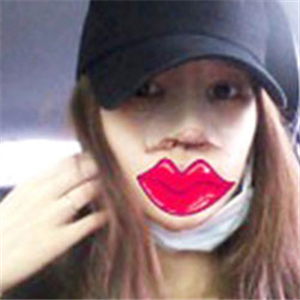 玻尿酸注射隆鼻手術(shù)三個月了，分享我的恢復過程，還有對比照片哦~