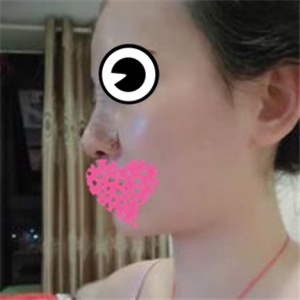 分享我的硅膠假體隆鼻手術(shù)恢復過程和前后對比果圖片哦~