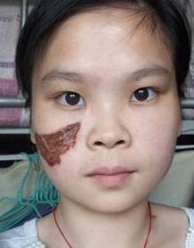 激光去胎記，去大田痣