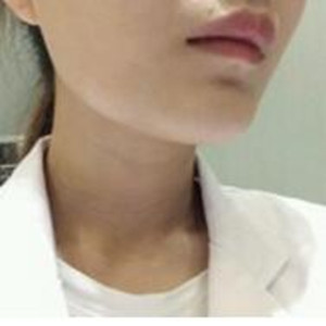 玻尿酸注射去頸紋果真的很明X哦 大家可以去試試