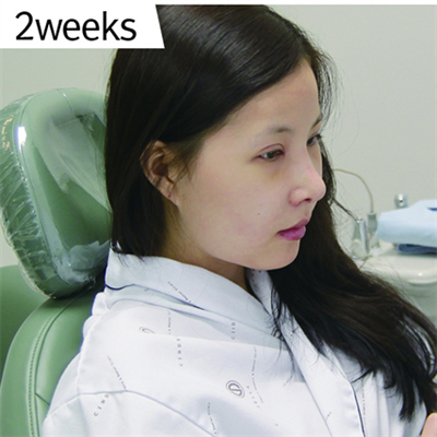 曹仁昌做的雙眼皮，分享下恢復(fù)前后對比果照片哦~