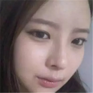 做了磨顴骨和面部脂肪填充，分享前后對比果圖片哦~