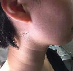 高強(qiáng)度聚焦超聲去頸紋前圖片