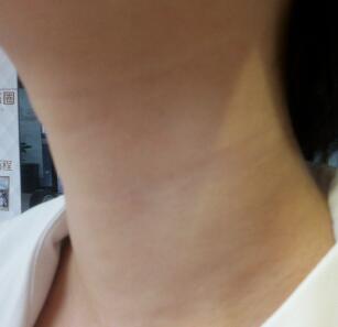 做完高強(qiáng)度聚焦超聲去頸紋美容圖片