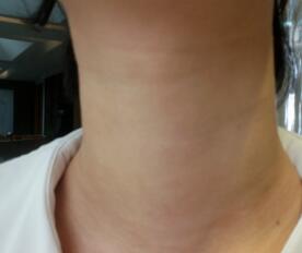 高強(qiáng)度聚焦超聲去頸紋美容后圖片