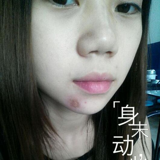 在廈門*菲做的激光祛疤過程分享