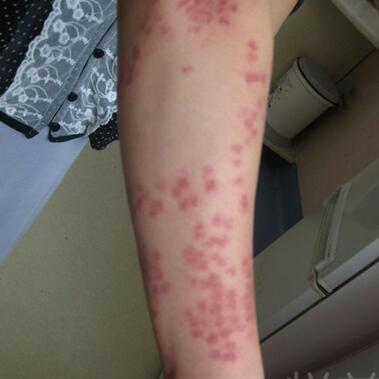 激光祛紅色胎記和跟隨了我20多年的胎記終于說拜拜了