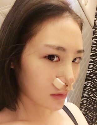 在隆鼻整形之后終于有了超精致的鼻子，尹度龍做的喲