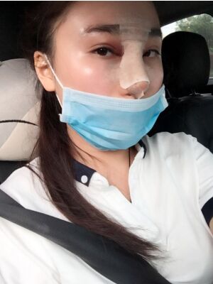 膨體隆鼻改變了我的塌鼻子，整體都精致不少