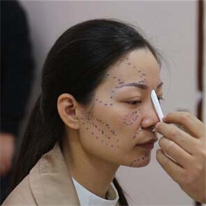 鼻部綜合整形+自體脂肪豐蘋(píng)果肌前后對(duì)比果圖片分享哦~