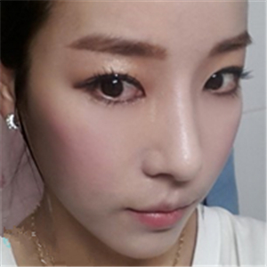 廣州博仕做了隆鼻整形半年了，分享恢復(fù)過(guò)程和前后對(duì)比果照片哦~